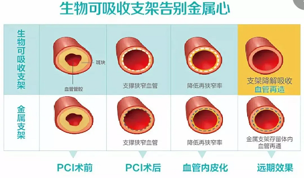 冠心病患者福音！我院成功完成首例可吸收支架植入！